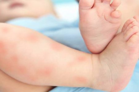 Que Faire En Cas D Eczema Du Bebe Quels Soins Appliquer